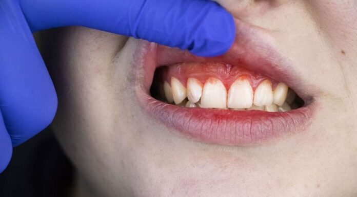 Inflamed Gums: Herbal Remedies Can Provide Relief Inflamed Gums