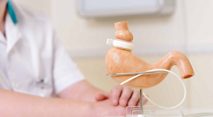 Gastric banding vs gastric sleeve Gastric banding vs gastric sleeve