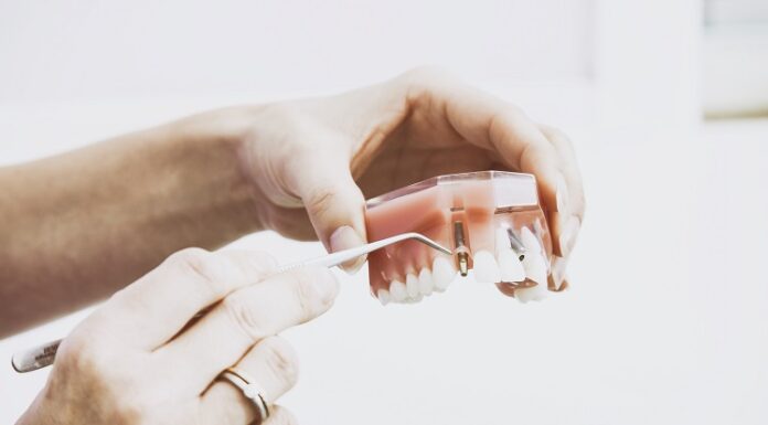 What are the Top Benefits of Dental Implants? Dental Implants