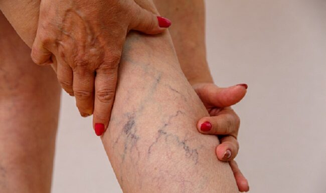 Causes of Varicose Veins Varicose Veins