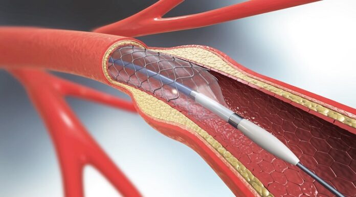 Everything You Should Expect During Treatment with Peripheral Artery Angioplasty Artery Angioplasty