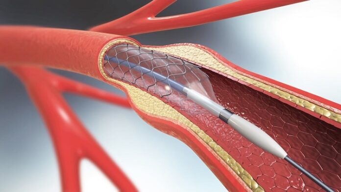 Artery Angioplasty