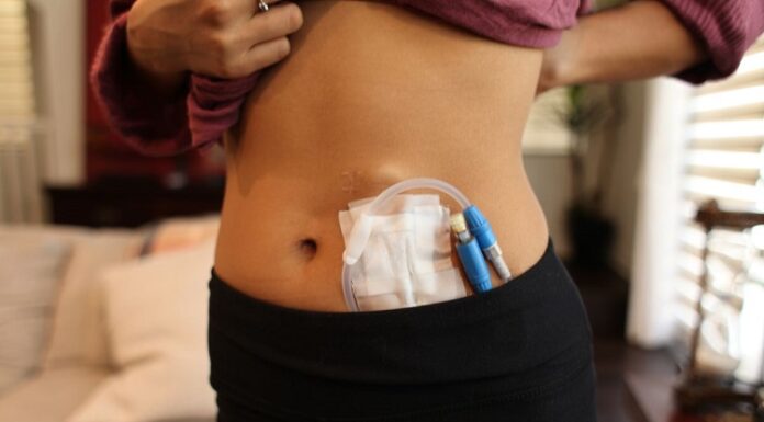How Is A Kidney Transplant Performed? Kidney Transplant