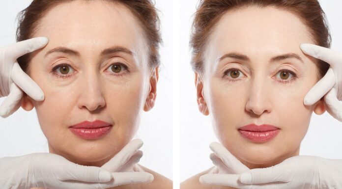 Mini Neck Lift Services- All You Need To Know Mini Neck Lift