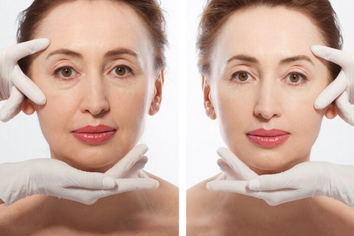 Mini Neck Lift