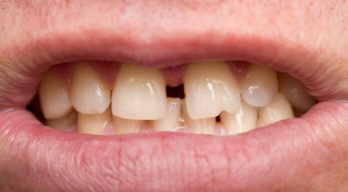The need for braces Liverpool braces