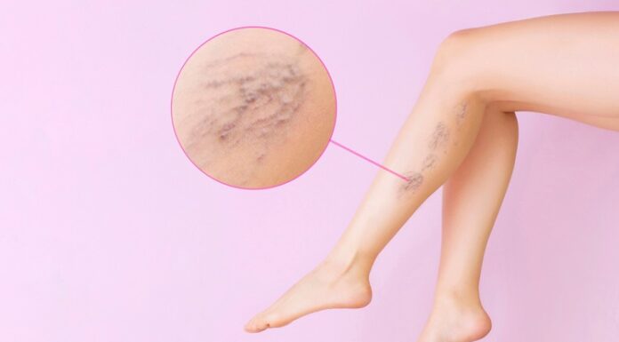 Everything To Know About Varicose Veins Varicose Veins