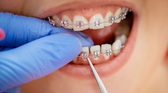 When Do You Need Two-Phase Orthodontic Treatment? Orthodontic Treatment