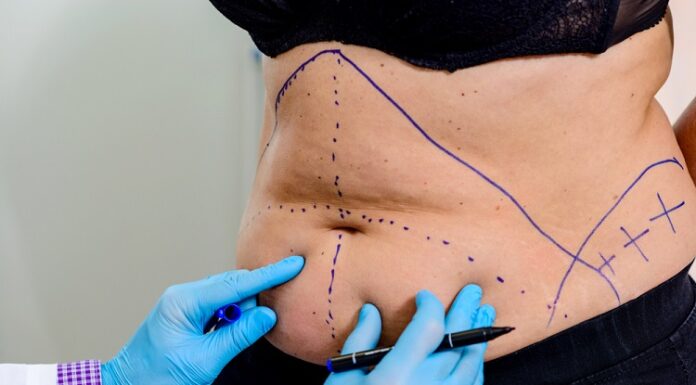 Maintaining Your Tummy Tuck Results Tummy Tuck