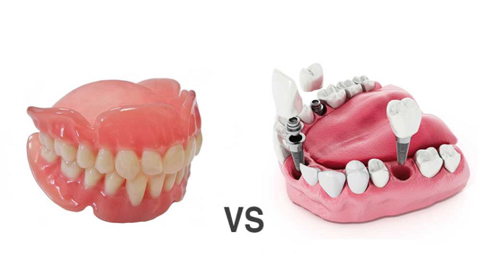 Dental Implants vs. Dentures: Which Is the Right Choice for Los Angeles Residents? Dental Implants