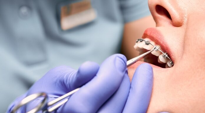 The Role of Retainers after Braces: Preserving Your Straight Smile Braces